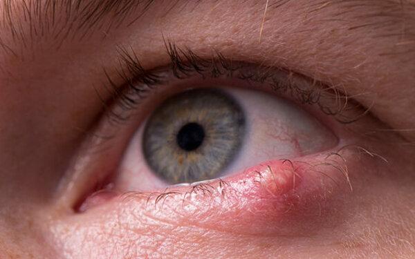 Gerstenkorn am Auge: Was es ist und wie man es behandelt