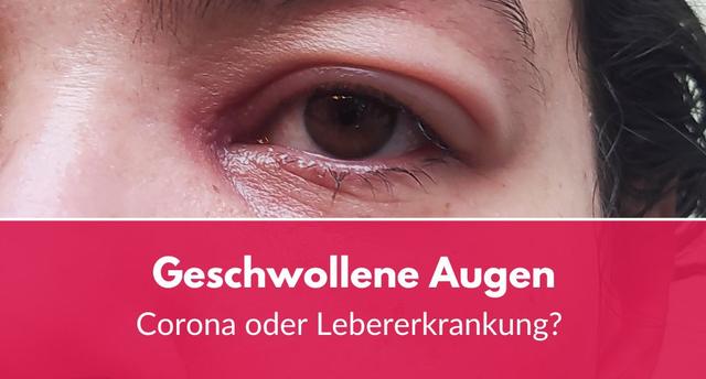 Ab wann sollte man mit geschwollenem Augenlid einen Arzt aufsuchen? Ab wann sollte man mit geschwollenem Augenlid einen Arzt aufsuchen?