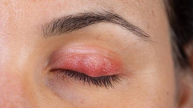 Geschwollenes Augenlid: Wann ist ärztlicher Rat erforderlich? Geschwollenes Augenlid: Wann ist ärztlicher Rat erforderlich?