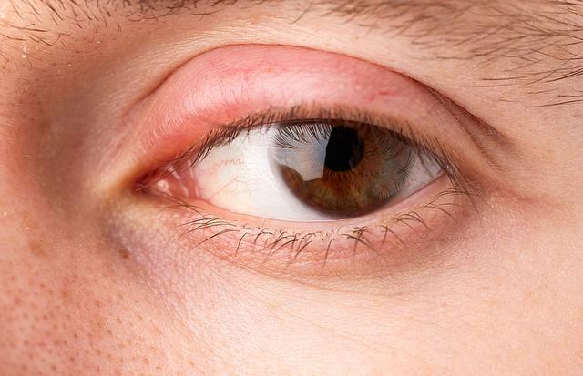 Wann sollte man mit geschwollenem Augenlid zum Arzt gehen? Wann sollte man mit geschwollenem Augenlid zum Arzt gehen?