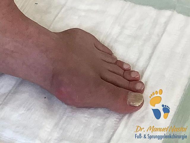 Wie lange dauern die Schmerzen bei einem Gichtanfall im Fuß an? Wie lange dauern die Schmerzen bei einem Gichtanfall im Fuß an?