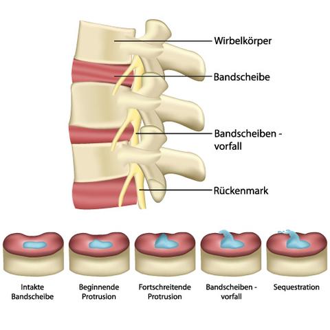 Einschätzung des Grades der Behinderung bei Bandscheibenvorfall HWS: Prozentsatz