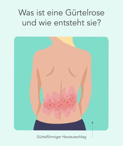 Gürtelrose: Wie lange bleibt sie ansteckend? Gürtelrose: Wie lange bleibt sie ansteckend?