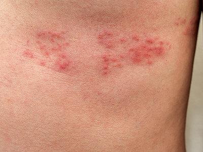 Ansteckungszeitraum bei Gürtelrose: Wie lange dauert er? Ansteckungszeitraum bei Gürtelrose: Wie lange dauert er?