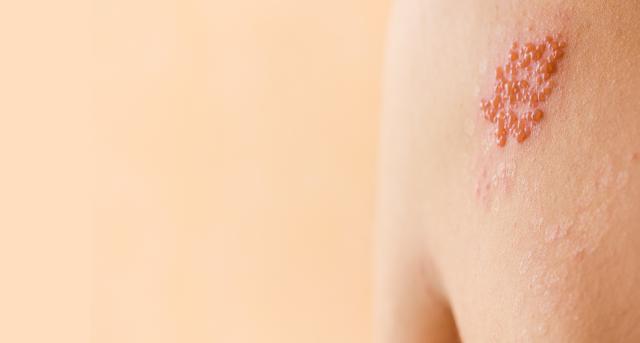 Wann ist der beste Zeitpunkt für die Gürtelrose-Impfung? Wann ist der beste Zeitpunkt für die Gürtelrose-Impfung?