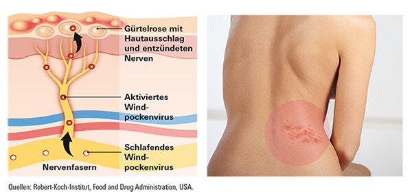 Warum wird die Impfung gegen Gürtelrose ab einem bestimmten Alter empfohlen? Warum wird die Impfung gegen Gürtelrose ab einem bestimmten Alter empfohlen?