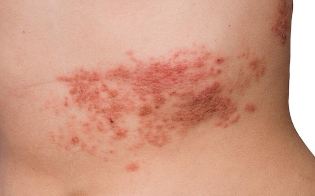 Ab welchem Alter sollte man sich gegen Gürtelrose impfen lassen? Ab welchem Alter sollte man sich gegen Gürtelrose impfen lassen?