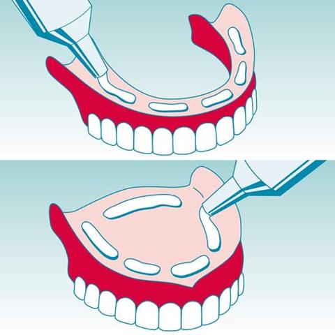 Haftcreme ohne Chemie: Selbstgemachte Lösungen für gut sitzende Zähne