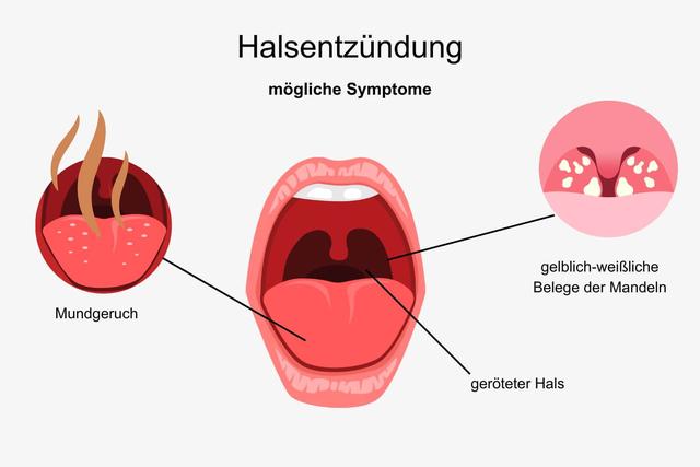 Halsentzündung: Ursachen, Symptome und Behandlungsmöglichkeiten