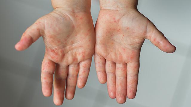 Wie lange sollte man zu Hause bleiben mit Hand-Mund-Fuß? Wie lange sollte man zu Hause bleiben mit Hand-Mund-Fuß?