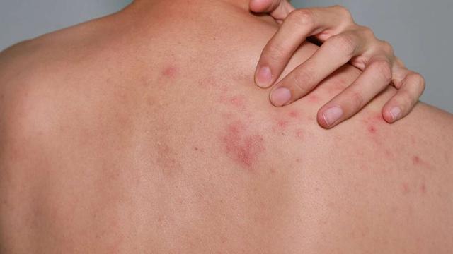 Häufigkeit von Herpes zoster: