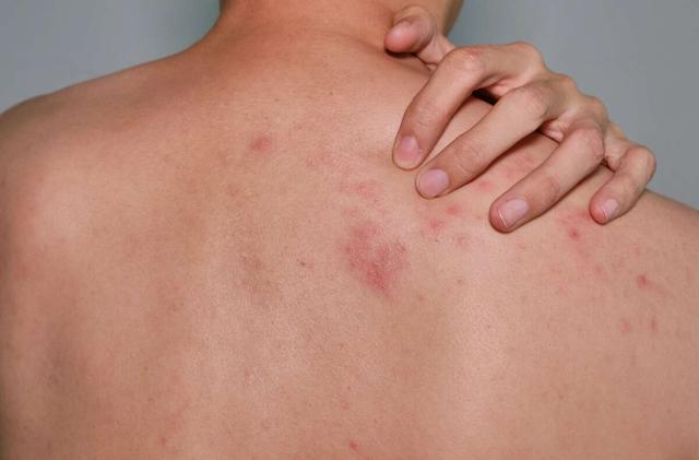 Gürtelrose-Wiederholungsrisiko: