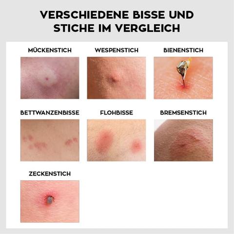 Juckende Pusteln: Tipps zur Behandlung von allergischen Hautreaktionen