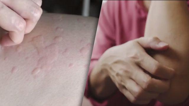 Juckende Pusteln: Mögliche Ursachen und Hausmittel zur Linderung