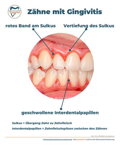Natürliche Wege zur Linderung von Zahnfleischentzündungen