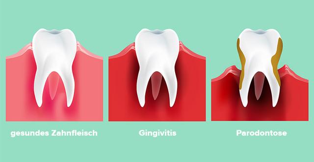 Was tun gegen Zahnfleischentzündung? Wirksame Hausmittel und Tipps