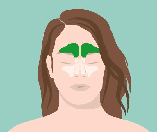 Chronische Stirnhöhlenentzündung: Symptome, Ursachen und Behandlungsoptionen Chronische Stirnhöhlenentzündung: Symptome, Ursachen und Behandlungsoptionen