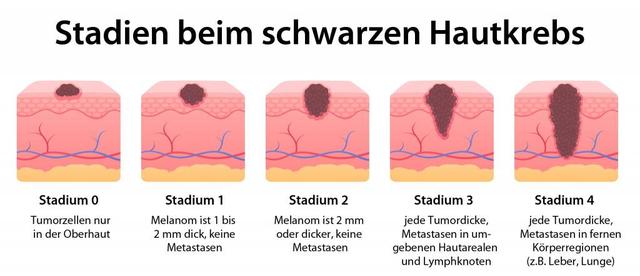 Hautkrebs rechtzeitig erkennen: Symptome, Risikofaktoren und Früherkennungsmaßnahmen Hautkrebs rechtzeitig erkennen: Symptome, Risikofaktoren und Früherkennungsmaßnahmen