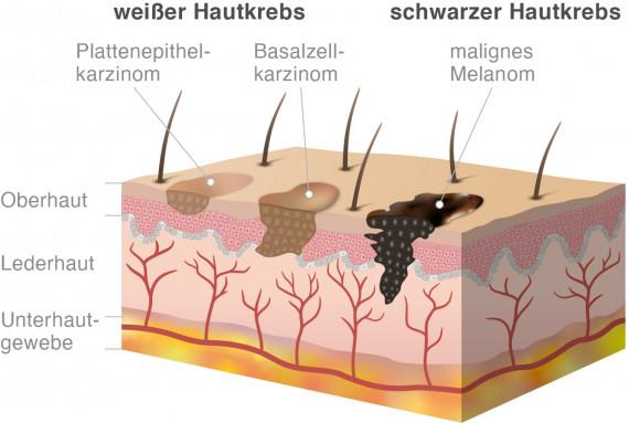 Wann ist es zu spät für Hautkrebs? Ursachen, Symptome und Stadien des malignen Melanoms Wann ist es zu spät für Hautkrebs? Ursachen, Symptome und Stadien des malignen Melanoms