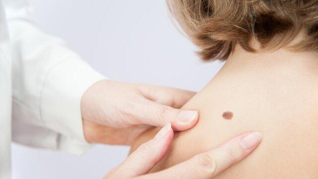 Ab welchem Zeitpunkt sollte man das Hautkrebsscreening in Betracht ziehen? Ab welchem Zeitpunkt sollte man das Hautkrebsscreening in Betracht ziehen?