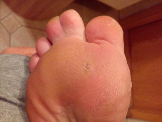 Wie lange dauert es, bis man nach einem gebrochenen kleinen Zeh wieder laufen kann? Wie lange dauert es, bis man nach einem gebrochenen kleinen Zeh wieder laufen kann?