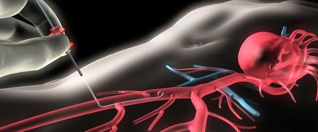 Moderne Techniken und Anwendungen von Herzkathetern Moderne Techniken und Anwendungen von Herzkathetern