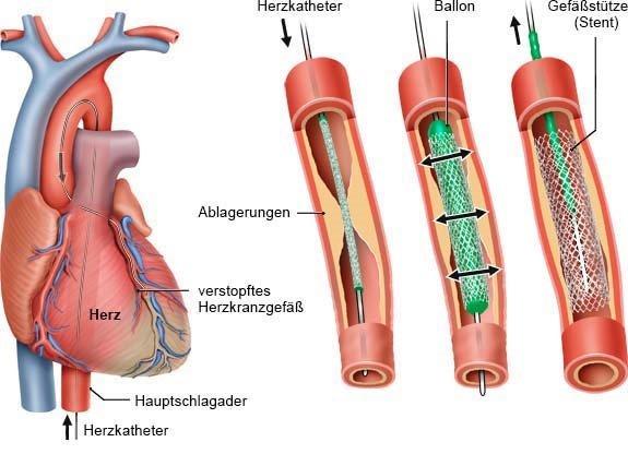 Herzkatheter: Definition, Verfahren und Anwendungsbereiche Herzkatheter: Definition, Verfahren und Anwendungsbereiche