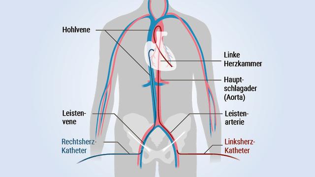 Herzkatheter: Diagnose und Therapie des Herzens im Fokus Herzkatheter: Diagnose und Therapie des Herzens im Fokus