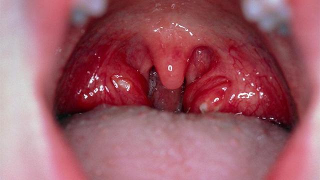 Mandelentzündung lindern: Hausmittel und Medikamente bei geschwollenen Mandeln