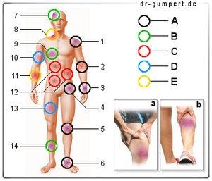 Was tun bei Prellungen nach einem Sturz? Effektive Maßnahmen zur Schmerzlinderung und Heilung Was tun bei Prellungen nach einem Sturz? Effektive Maßnahmen zur Schmerzlinderung und Heilung