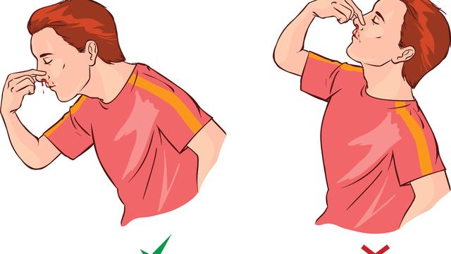 Nasenbluten richtig stoppen: Hilfreiche Tipps für den Ernstfall Nasenbluten richtig stoppen: Hilfreiche Tipps für den Ernstfall