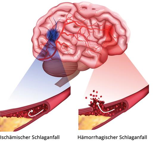 Sturzrisiko bei älteren Menschen: Wie lange dauert die Gefahr einer Hirnblutung an?