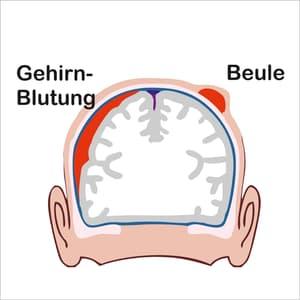 Hirnblutungen nach Stürzen: Wie lange müssen Senioren aufpassen?