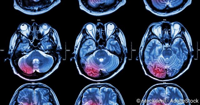 Sturzgefahr bei älteren Menschen: Wie lange besteht das Risiko einer Hirnblutung?