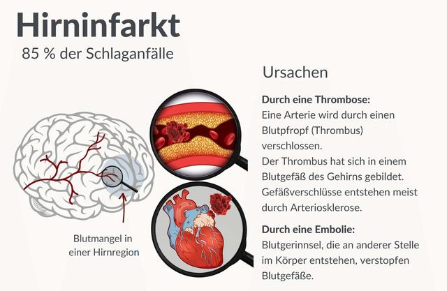 6. Langzeitfolgen und Prävention von Hirnschlägen 6. Langzeitfolgen und Prävention von Hirnschlägen