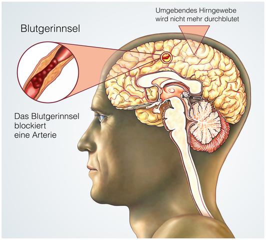 1. Was ist ein Hirnschlag und wie entsteht er? 1. Was ist ein Hirnschlag und wie entsteht er?