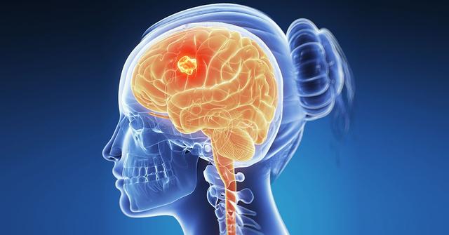 Die Anfangsstadien von Hirntumoren werden häufig übersehen