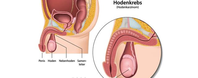 Früherkennung von Hodenkrebs: Das Aussehen der Krankheit verstehen Früherkennung von Hodenkrebs: Das Aussehen der Krankheit verstehen