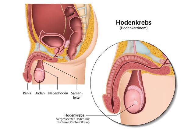 Was Sie über das Erscheinungsbild von Hodenkrebs wissen sollten Was Sie über das Erscheinungsbild von Hodenkrebs wissen sollten