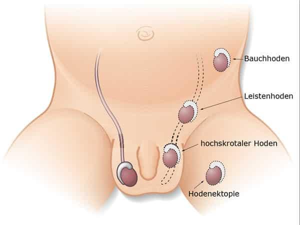 Hodenkrebs-Op: Warum eine frühzeitige Operation entscheidend ist Hodenkrebs-Op: Warum eine frühzeitige Operation entscheidend ist