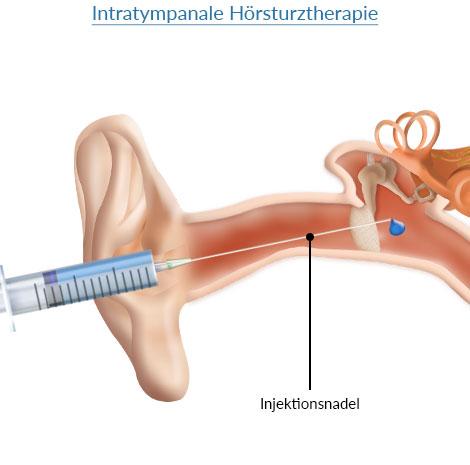 Hörsturz: Behandlungsmöglichkeiten und Maßnahmen Hörsturz: Behandlungsmöglichkeiten und Maßnahmen