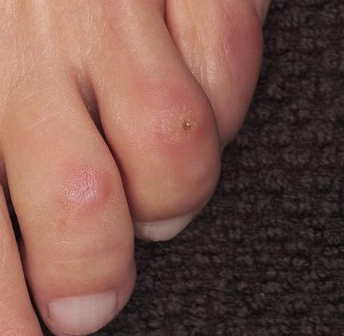 Wie man ein Hühnerauge selbst entfernt: Schritt-für-Schritt-Anleitung