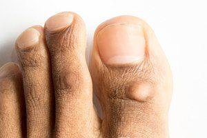 Effektive Methoden zur Selbstbehandlung von Hühneraugen