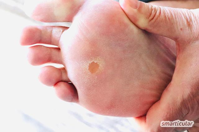 Hühnerauge selbst entfernen: Tipps und Tricks für die Behandlung zu Hause