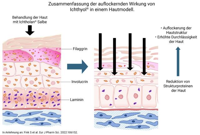Zugsalbe: Wie funktioniert Ichtholan® bei eitrigen Hautentzündungen? Zugsalbe: Wie funktioniert Ichtholan® bei eitrigen Hautentzündungen?
