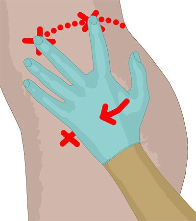 Selbstinjektion am Gesäß: Alles, was Sie wissen müssen Selbstinjektion am Gesäß: Alles, was Sie wissen müssen