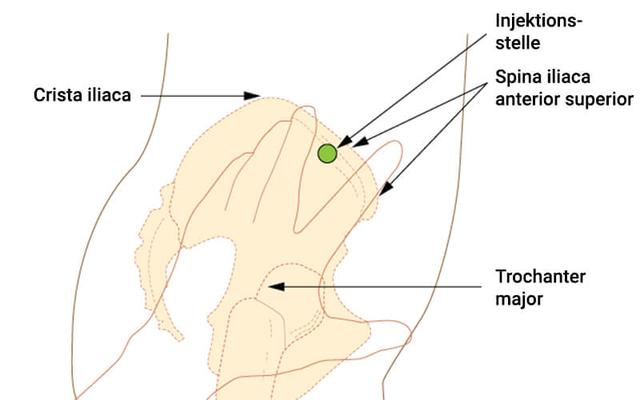 Praktische Anleitung: Wie man eine intramuskuläre Injektion am Gesäß selbst durchführt Praktische Anleitung: Wie man eine intramuskuläre Injektion am Gesäß selbst durchführt