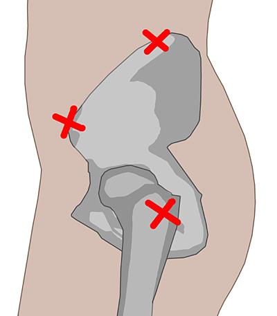 Selbstinjektion am Po: Tipps und Hinweise für eine erfolgreiche Durchführung Selbstinjektion am Po: Tipps und Hinweise für eine erfolgreiche Durchführung