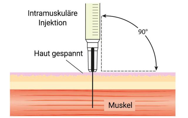 Anleitung zur intramuskulären Injektion am Gesäß für Selbstanwendung Anleitung zur intramuskulären Injektion am Gesäß für Selbstanwendung