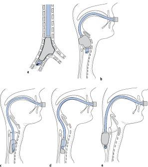 5. Unterschiede zwischen endotrachealer und nasotrachealer Intubation